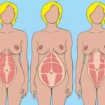 diastáza priamych brušných svalov